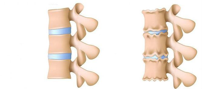 Osteochondrosis of the lumbar area