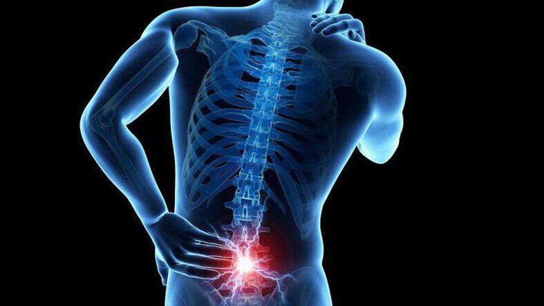 Symptoms of lumbar osteochondrosis